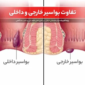 درمان بواسیر