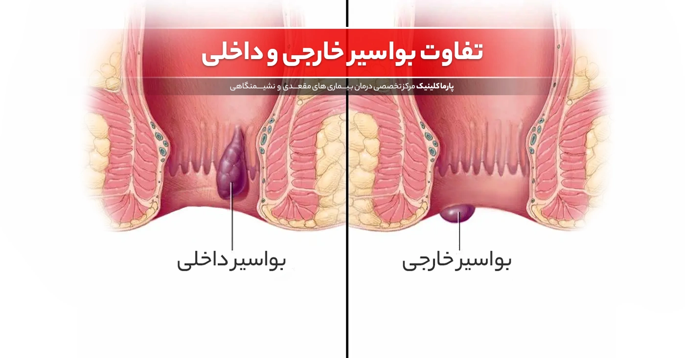 درمان بواسیر